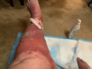 Lymphedema Cellulitis