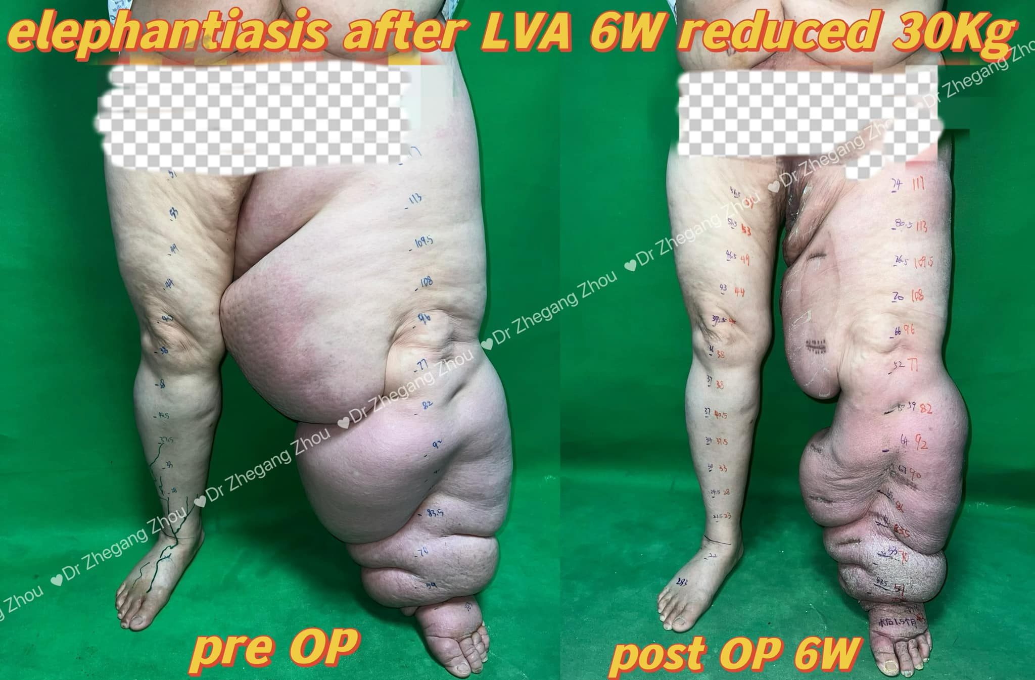 Lymphedema LVA